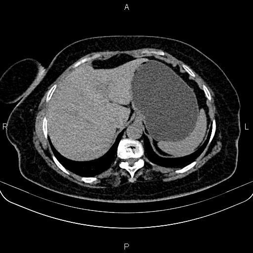 Adrenal myelolipoma (Radiopaedia 82742-96986 Axial non-contrast 24).jpg