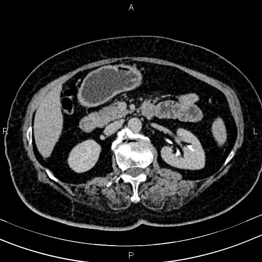 Adrenal myelolipoma (Radiopaedia 82742-96986 Axial renal excretory phase 58).jpg