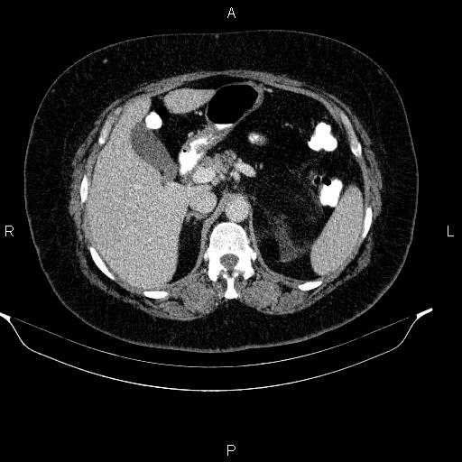 File:Adrenal myelolipoma (Radiopaedia 84319-99617 Axial renal cortical phase 37).jpg