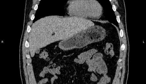 Adrenal myelolipoma (Radiopaedia 84321-99619 Coronal non-contrast 18).jpg