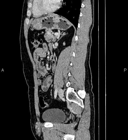 Adrenal myelolipoma (Radiopaedia 87794-104246 Sagittal renal cortical phase 60).jpg