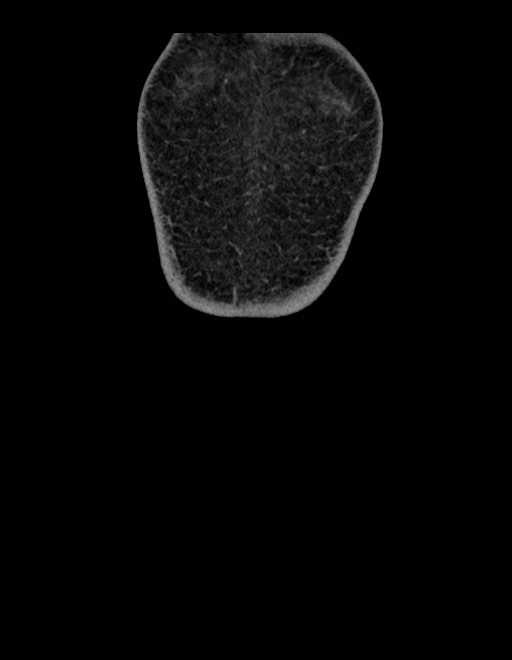 Adrenal myelolipoma - bilateral (Radiopaedia 74805-85810 Coronal C+ portal venous phase 267).jpg