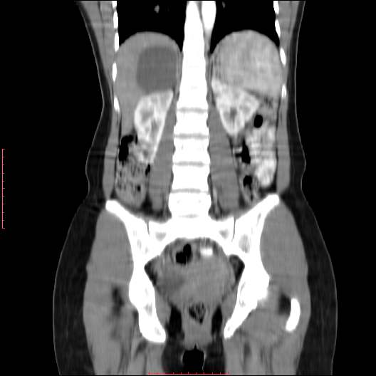File:Adrenal pseudocyst (Radiopaedia 44419-48073 Coronal C+ portal venous phase 12).jpg