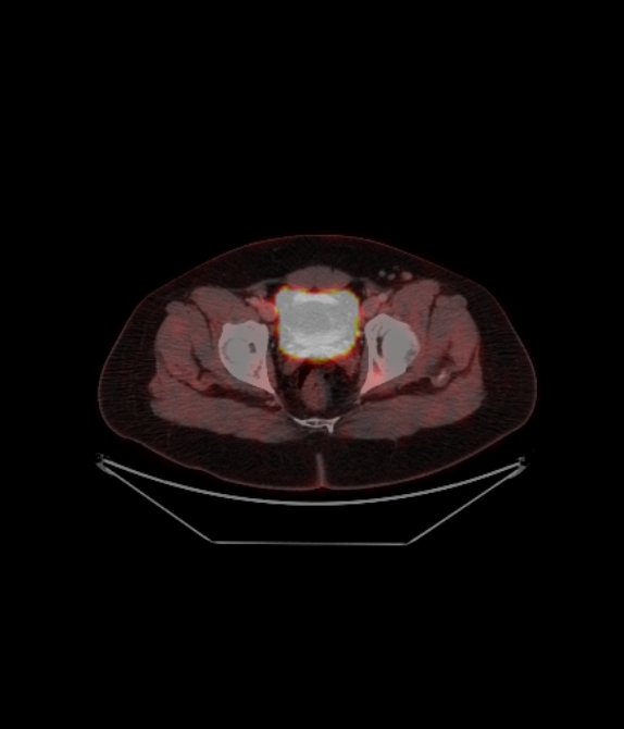 Adrenocortical carcinoma (Radiopaedia 80134-93440 ِAxial 245).jpg