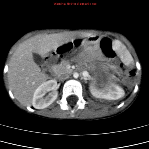 File:Adrenocortical carcinoma (Radiopaedia 9449-10131 Axial C+ portal venous phase 22).jpg