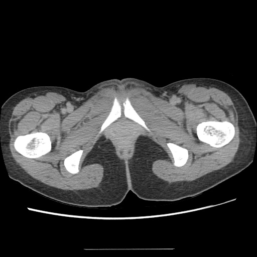 Adult polycystic kidney disease (Radiopaedia 48845-53876 Axial renal excretory phase 102).jpg