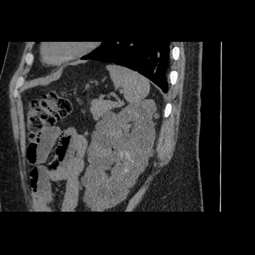 Adult polycystic kidney disease (Radiopaedia 59075-66368 Sagittal non-contrast 70).jpg