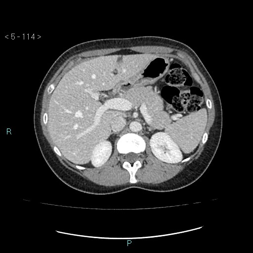 Adult transient intestinal intussusception (Radiopaedia 34853-36310 Axial C+ portal venous phase 6).jpg