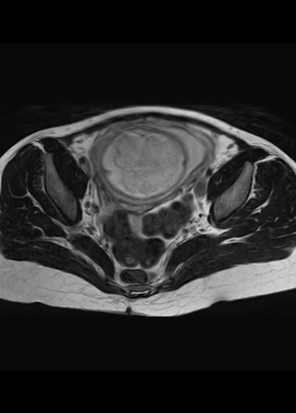 File:Aggressive angiomyxoma of the pelvis and perineum (Radiopaedia 59162-66479 Axial T2 14).jpg