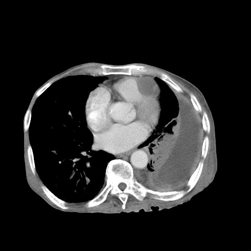Aggressive lung cancer with cardiac metastases, pulmonary artery tumor thrombus, and Budd-Chiari (Radiopaedia 60320-67981 A 35).jpg