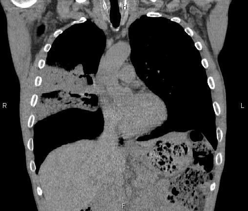 Air bronchogram in pneumonia (Radiopaedia 85719-101512 Coronal non-contrast 24).jpg
