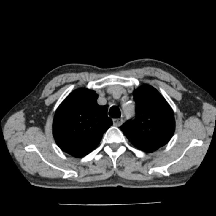 Airway foreign body in adult (Radiopaedia 85907-101779 Axial liver window 23).jpg