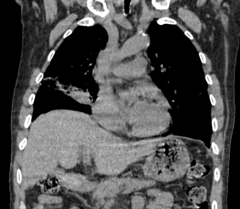 Airway foreign body in adult (Radiopaedia 85907-101779 Coronal liver window 109).jpg