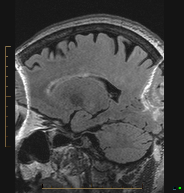 Aliasing artifact causing a spurious cerebellar lesion (Radiopaedia 48783-53810 Sagittal FLAIR 15).jpg