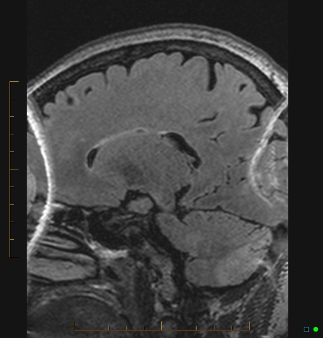 Aliasing artifact causing a spurious cerebellar lesion (Radiopaedia 48783-53810 Sagittal FLAIR 68).jpg