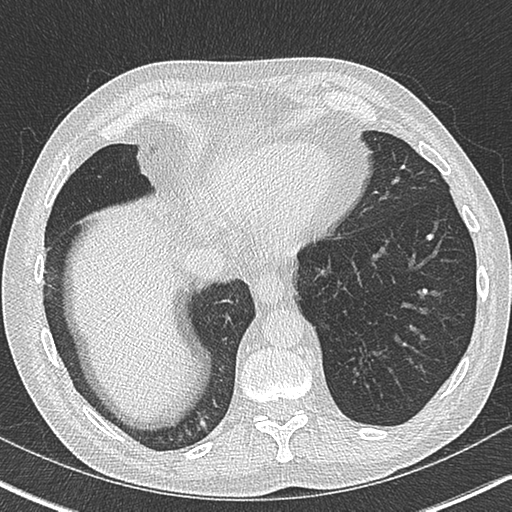 File:Allergic bronchopulmonary aspergillosis (Radiopaedia 44760-48571 Axial lung window 51).png