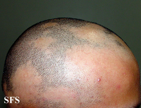 Alopecia Areata (Dermatology Atlas 23).jpg