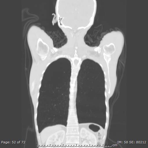 Alpha-1-antitrypsin deficiency (Radiopaedia 50561-55987 Coronal lung window 50).jpg