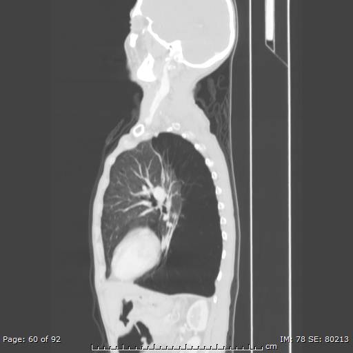 File:Alpha-1-antitrypsin deficiency (Radiopaedia 50561-55987 Sagittal lung window 29).jpg