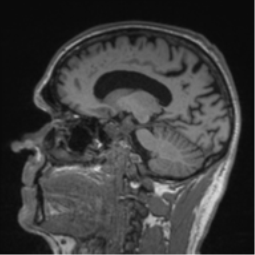 Alzheimer's disease- with Gerstmann syndrome and dressing apraxia (Radiopaedia 54882-61150 Sagittal T1 28).png