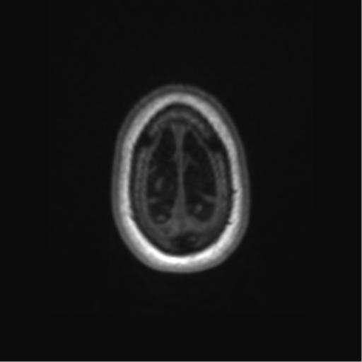 Alzheimer's disease (Radiopaedia 42658-45802 Axial T1 17).png