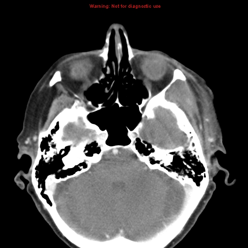 Ameloblastoma (Radiopaedia 27437-27631 A 4).jpg