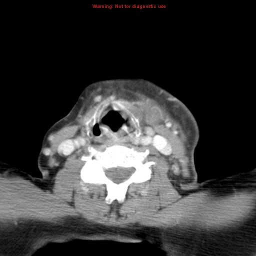 Ameloblastoma (Radiopaedia 27437-27631 A 63).jpg