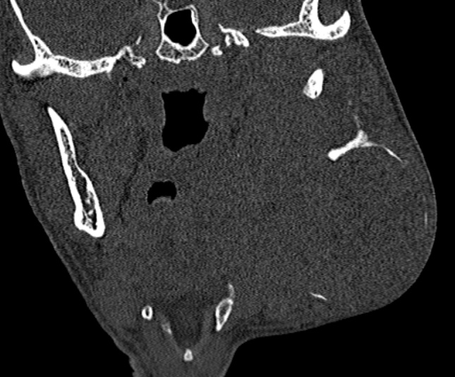 Ameloblastoma (Radiopaedia 51921-57766 Coronal bone window 157).jpg