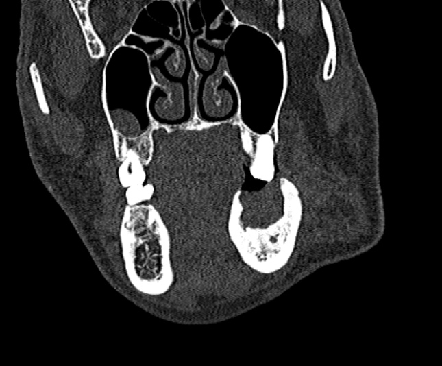 Ameloblastoma (Radiopaedia 51921-57766 Coronal bone window 78).jpg