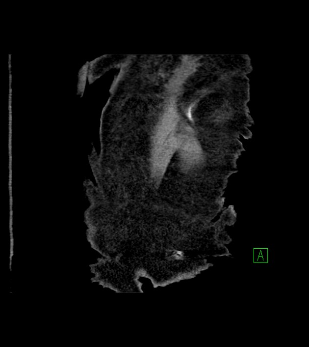 Amiodarone deposition in the liver (Radiopaedia 77587-89780 Coronal non-contrast 76).jpg