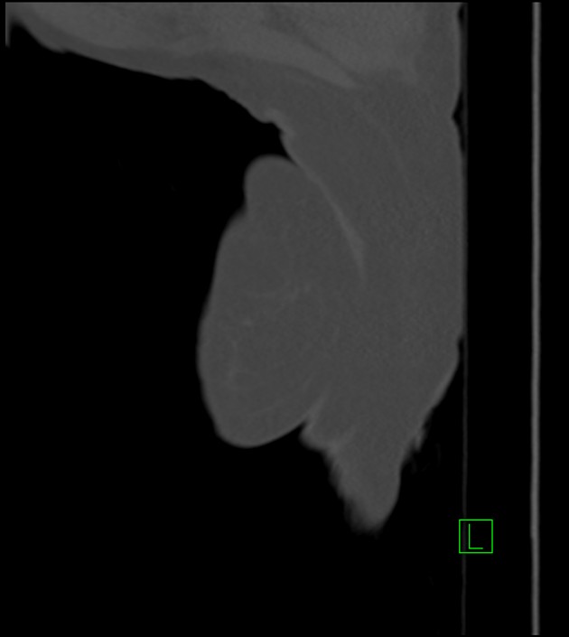 Amiodarone deposition in the liver (Radiopaedia 77587-89780 Sagittal bone window 102).jpg