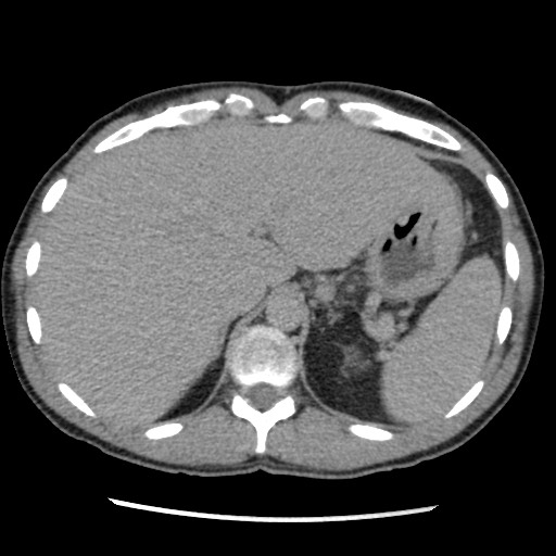 Amoebic liver abscesses (Radiopaedia 55536-62009 Axial C+ delayed 22).jpg