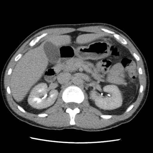 Amoebic liver abscesses (Radiopaedia 55536-62009 Axial C+ delayed 34).jpg