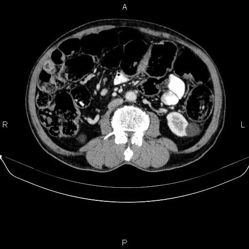 File:Ampullary adenocarcinoma (Radiopaedia 86093-102032 A 31).jpg