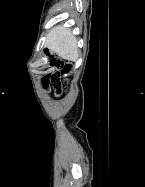 Ampullary adenocarcinoma (Radiopaedia 86093-102032 D 3).jpg