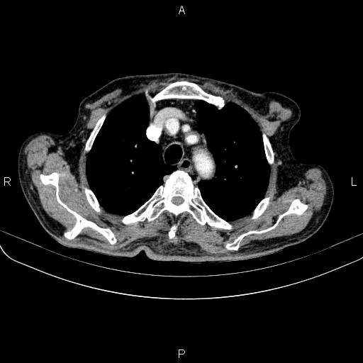 Ampullary adenocarcinoma (Radiopaedia 86093-102033 B 21).jpg