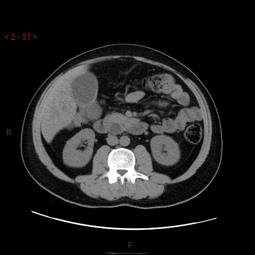 File:Ampullary carcinoma (Radiopaedia 56396-63056 Axial non-contrast 25).jpg
