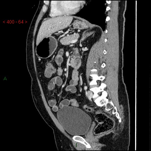 Ampullary carcinoma (Radiopaedia 56396-63056 D 63).jpg