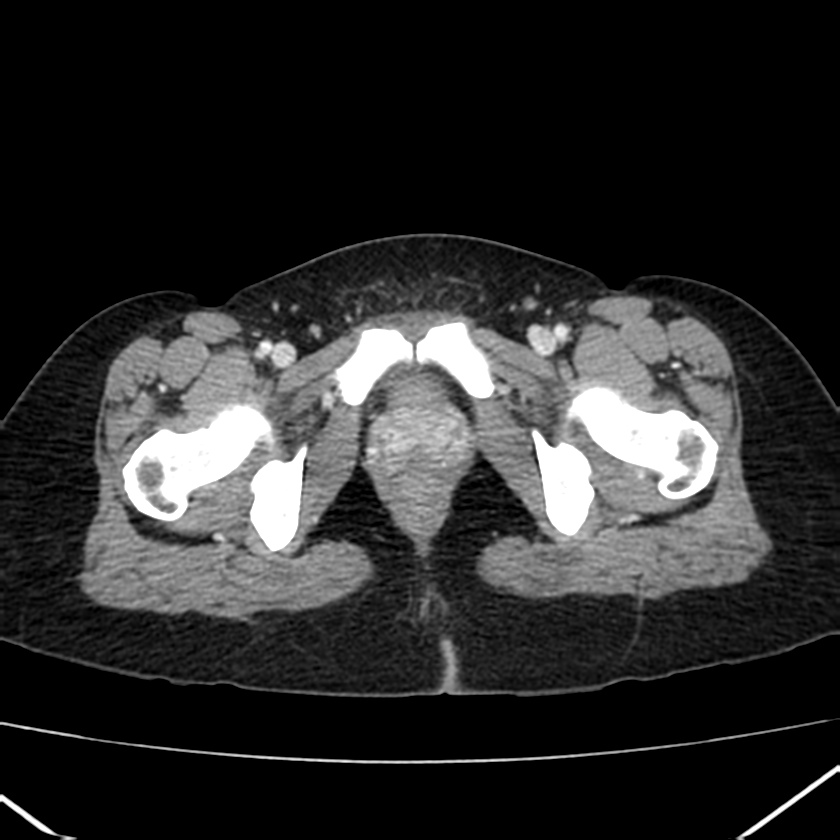 Ampullary tumor (Radiopaedia 22787-22816 C 70).jpg