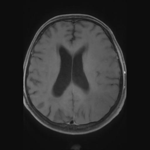 File:Amyloid angiopathy with inflammation (Radiopaedia 30360-31002 Axial T1 C+ fat sat 20).jpg