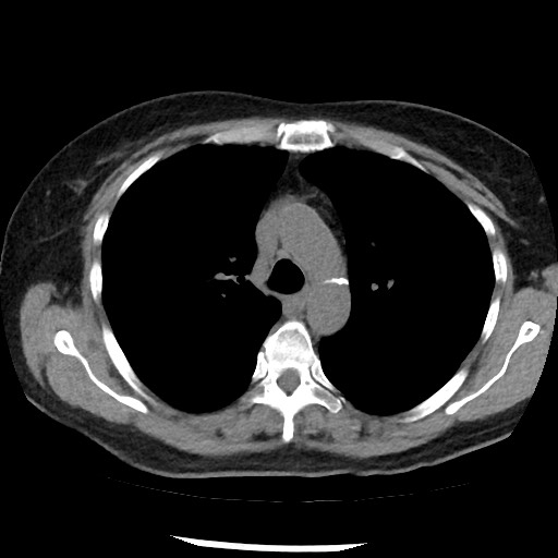 Amyloidosis - bronchial and diffuse nodular pulmonary involvement (Radiopaedia 60156-67744 Axial non-contrast 20).jpg