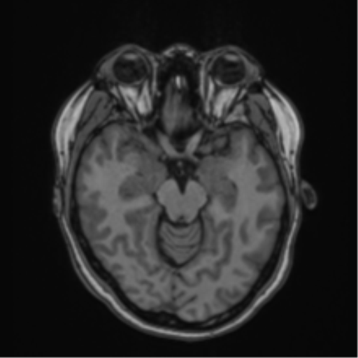Anaplastic astroblastoma (Radiopaedia 55666-62194 Axial T1 29).png