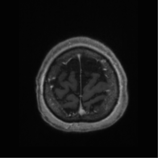 Anaplastic astrocytoma IDH wild-type (pseudoprogression) (Radiopaedia 42209-45277 Axial T1 C+ 116).png