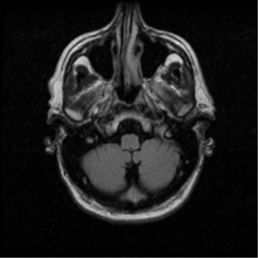 File:Anaplastic meningioma with recurrence (Radiopaedia 34452-35789 Axial FLAIR 4).png