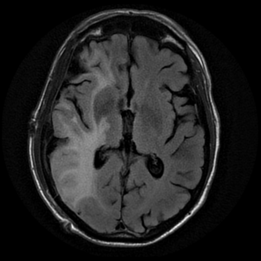 File:Anaplastic meningioma with recurrence (Radiopaedia 34452-35791 Axial FLAIR 11).png