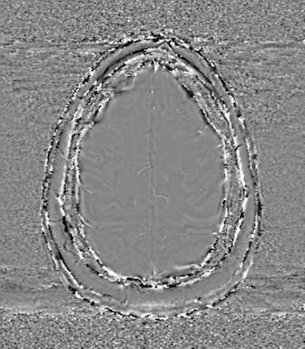 Anaplastic oligodendroglioma (Radiopaedia 83500-98599 Axial SWI - phase 70).png