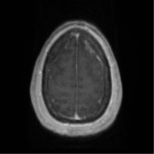 Anaplastic oligodendroglioma (Radiopaedia 83500-98599 Axial T1 C+ 65).png