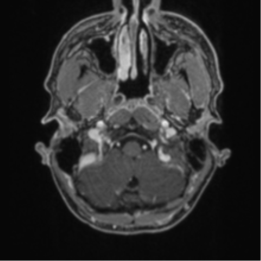 Anaplastic oligodendroglioma with skull fracture (Radiopaedia 74831-85845 Axial T1 C+ fat sat 1).png