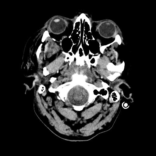 Aneursym related subarachnoid hemorrhage with hydrocephalus (Radiopaedia 45105-49085 Axial non-contrast 2).jpg