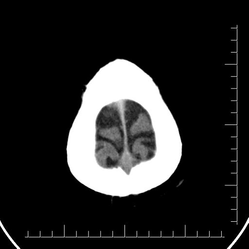 File:Aneurysm of posterior communicating artery (Radiopaedia 20188-20162 Axial non-contrast 46).jpg